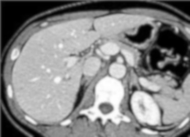 Breast cancer patient benefits from modified immunotherapy